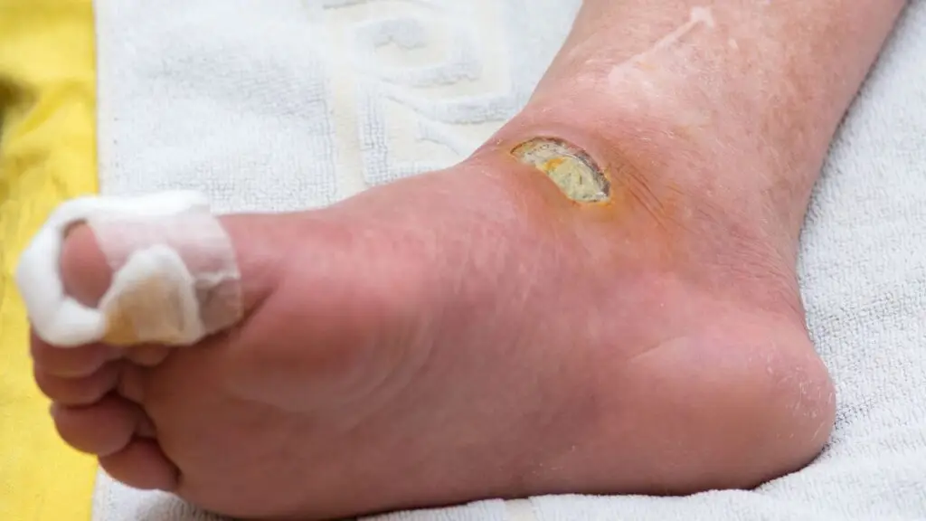 Prevenzione, inquadramento clinico e gestione delle complicanze del piede diabetico